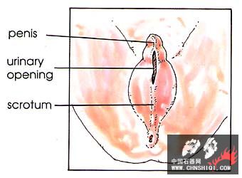 裂阴囊 Cleft Scrotum.jpg